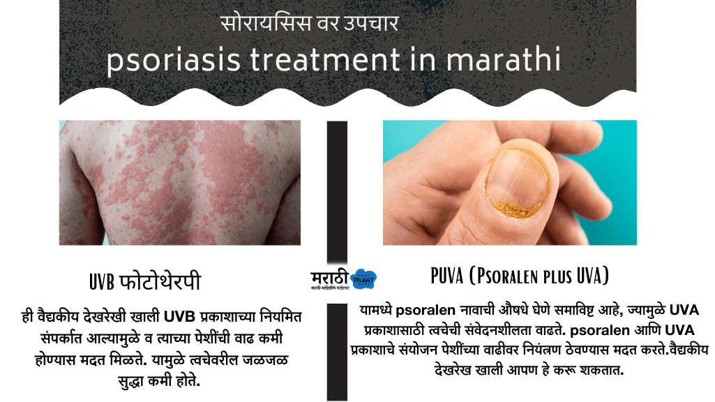 Psoriasis Treatment at home In Marathi